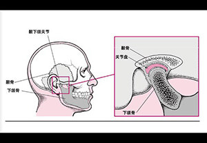 顳下頜關(guān)節(jié)紊亂病