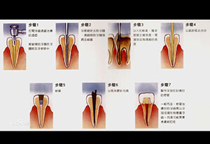 看著都疼的牙齒根管治療全過(guò)程